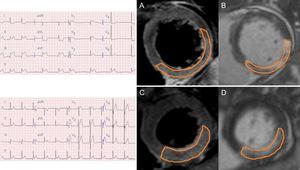 Representative cardiac magnetic resonance images from a study of nonanterior ST-segment elevation myocardial infarction with and without reciprocal change. A: a short-axis slice of a T2-weighted image with reciprocal change. B: a short-axis slice of a late-gadolinium enhancement image with reciprocal change. C: a short-axis slice of a T2-weighted image without reciprocal change. D: a short-axis slice of a late-gadolinium enhancement image without reciprocal change.