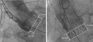 Examples of target (A) and deep (B) prosthesis implantation in the left ventricular outflow tract. Angiographic implantation depth was assessed as part of the prosthesis protruding from the virtual aortic annulus in the left ventricular outflow tract.