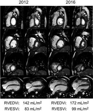 Progressive dilation of the right ventricle in a patient after repaired tetralogy of Fallot and pulmonary insufficiency demonstrated by cardiac magnetic resonance imaging. Short axis stack (basal, upper row; midventricular, second row; apical, third row) and 4-chamber view (lower row) of cine steady-state free precession end-diastolic (first and third columns) and end-systolic (second and fourth columns) images of the same patient in 2012 and 2016. Note the progression of the dilation of the right ventricle. RVEDVi, right ventricle end-diastolic volume index; RVESVi, right ventricle end-systolic volume index.