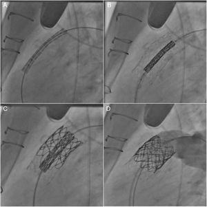 Percutaneous pulmonary valve implantation in a dysfunctional right ventricle outflow tract (homograft). After extensive prestenting (A, B) a 22-mm Melody valve was positioned (C) and successfully deployed, without post-procedural regurgitation (D).