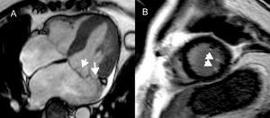 Late gadolinium enhancement on cardiac magnetic resonance in patients with mitral valve prolapse. Horizontal long axis steady state free precession image, demonstrating bileaflet prolapse of the mitral valve (A). Short axis view, with late gadolinium enhancement of the papillary muscle tips (B), which has been linked to ventricular arrhythmias.95 Reproduced with permission from van der Bijl et al.4.