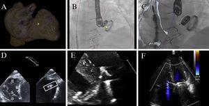 Multimodal imaging during implantation. Fusion of images with computed tomography (A-B); the marker that identified the desired clip position can be seen between the septal and anterior leaflets (yellow dot). C: fusion of images with echocardiography. D: echocardiography to assess coaxiality. E: grasping. F: final result.