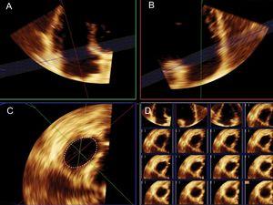 Measurement of tricuspid annulus area using 3-dimensional transthoracic echocardiography. Sliced 3-dimensional volume. After careful orientation of the annular plane position using 2 orthogonal planes (A and B) the projection of the tricuspid annulus is obtained to measure tricuspid annulus area (C). Right lower panel (D) shows the multislice imaging of the tricuspid annulus.