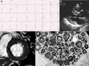 A: the patient's electrocardiogram showing short PR interval, left ventricular hypertrophy, and subepicardial ischemia. B and C: echocardiogram and cardiac magnetic resonance with left ventricular hypertrophy. D: electron microscopy images of the renal biopsy with the “zebra bodies” (cluster of glycolipid concentric membranous bodies sequestered within lysosome).