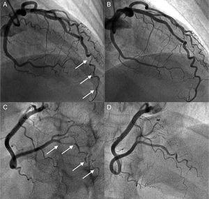Coronary angiogram in a hypothyroid patient with multiple spontaneous coronary artery dissections. A and B: angiogram of the anterior descending artery with type 2 dissection (intramural hematoma) with involvement of a distal corkscrew segment (arrows) and its resolution during follow-up. C and D: angiogram of the right posterolateral branch with type 2 dissection (arrows) and its resolution during follow-up.