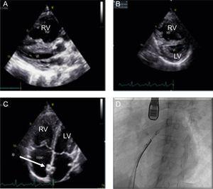 A: echocardiography, showing RV dilatation compressing the LV. B: type IV IVS and abnormal sphericity index, echocardiographic signs of severe PH. C: image of a correctly positioned stent (*). D: catheterization, positioning a stent with TEE guidance. IVS, interventricular septum; LV, left ventricle; RV, right ventricle; TEE, transesophageal echocardiography.