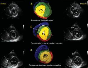 Echographic correlation with short-axis views in systole and diastole. Emphasis on 3 anatomic relationships: apical short-axis (A), papillary muscle short-axis (B), and mitral valve short-axis (C). The asterisk indicates the PPM. The dotted lines in A and B show that, according to the view angle used, the AS has a different appearance in the free wall of the LV; as the slice becomes more vertical, it passes more completely over the PPM, and as it becomes more oblique and passes through the anterior papillary muscle, the AS becomes more visible in the free wall of the LV and can be assessed. AS, ascending segment; LV, left ventricle; PPM, posterior papillary muscle; RV, right ventricle.