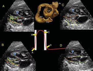 Four-chamber views and velocity vectors in 40.2-week fetal heart on ultrasound. A, velocity vectors (green arrows) from the LV base in the caudal direction during axial shortening motion. B, the vectors move toward the interior in the lateral wall and the upper portion of the IVS by DS contraction during ejection. C and D, start of the isovolumetric relaxation period in which the AS contracts, the velocity vectors in the lateral and outward direction in the cephalic direction, which leads to untwisting and axial elongation of the heart. Partially rolled up human heart. Wiggers diagram, showing velocity vector-related motion during the cardiac cycle. A, basal loop contraction. B, DS contraction. C, AS contraction, ventricular relaxation. Ao, aorta; AS, ascending segment; DS, descending segment; IVS, interventricular septum; LS, left segment; LV, left ventricle; PA, pulmonary artery; RS, right segment; RV, right ventricle.