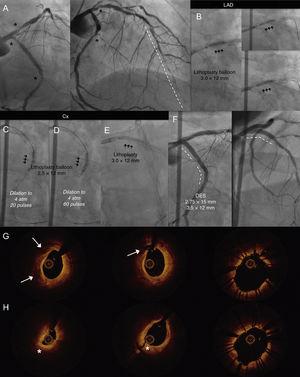 A: Calcified lesions in the ostial and medial-distal circumflex artery (Cx) and ostial left anterior descending artery (LAD) (asterisks) with diffuse disease in the distal LAD (dotted line). Coronary lithoplasty with a 3-mm balloon in the ostial DA (B) and the medial-distal Cx. Dilation to 4 atm and delivery of 20 pulses (C) and 60 pulses (D). E: Coronary lithoplasty with a 3-mm balloon in the ostial LAD. F: Placement of 3 drug-eluting stents, with good results; optical coherence tomography images before coronary lithoplasty; fracture of calcified plaque (arrows) and dissection of fibrous plaque (asterisks). G and H: Images after coronary lithoplasty and placement of stent in the ostial (G) and medial-distal Cx (H).