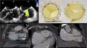 Imaging study. A: transesophageal echocardiography showing severe tricuspid regurgitation with separation (asterisk). B: GATE prosthesis. C: computed tomography study to measure the tricuspid annulus.