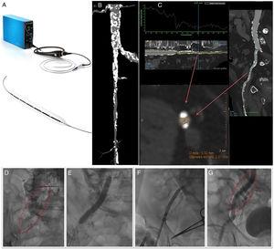 A: Shockwave Lithoplasty system. B and C: computed tomography images showing extensive calcification of the common iliac artery and the origin of the right external iliac artery, as well as the common femoral artery, which also had severe lesions in all segments with a minimum lumen diameter of 5.3×2.4mm. D: extensive calcification observed on fluoroscopy. E: lithoplasty balloon inflated to 7×60mm, over a 330cm Asahi RG3 0.014-inch guidewire. F: advancing a CoreValve Evolute Pro 29mm prosthesis across the calcified lesion. G: final condition of the artery after finishing the procedure; the fracture produced in the calcium can be seen without images of associated dissection.