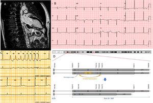 A: Cardiac magnetic resonance imaging. Late gadolinium enhancement is signaled with an arrow. B: Electrocardiogram. C: Holter Monitoring showing a nonsustained ventricular tachycardia. D: Schematic representation of the genetic variant. Upper alleles show normal nonrearranged exons. A,B,C,D,E regions denote theoretic portions of the exon that are rearranged in this complex mutation.