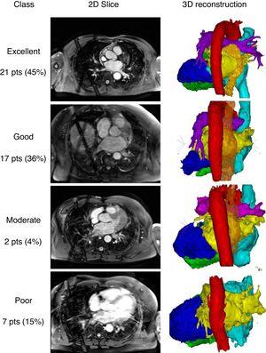 Examples of the 2-dimensional (2D) slices and 3-dimensional (3D) reconstructions. Classifications: excellent (without manual interaction); good (little manual interaction), moderate (extensive manual interaction); poor (left atrium anatomy and pulmonary vein orientation could not be reconstructed). Red, aorta; yellow, left atrium; orange, esophagus; bright blue, right atrium; dark blue, left ventricle; green, right ventricle; pts, patients.