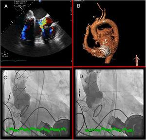 A: aortic regurgitation on transesophageal echocardiography. B: tomographic reconstruction. C: aortography showing severe regurgitation. D: transcatheter aortic valve implantation.