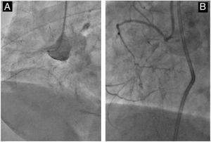 Types of aorto-ostial CTOs. A: flush aorto-ostial occlusion (total absence of a stump at the aortocoronary junction). B: aorto-ostial CTO with a minimal proximal cap. CTO: chronic total coronary occlusion.