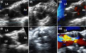 Transesophageal echocardiography images performed in structural valve degeneration patients (IA). Intraprocedural long-axis view of a SAPIEN XT showing thin THV leaflets (IB). Long-axis view of a SAPIEN XT performed 5.5 years after the implantation on a patient with THV due to stenosis, showing thickened and calcified leaflets (IIA). Intra-procedural short-axis view of a SAPIEN XT showing thin THV leaflets (IIB). Short-axis view of a SAPIEN XT performed 5.5 years after the THV implantation on a patient with THV due to stenosis, showing thickened and calcified leaflets (IIIA). Color-Doppler intraprocedural long-axis view of a SAPIEN XT showing thin THV leaflets and no residual aortic regurgitation (IIIB). Color-Doppler long-axis view of a SAPIEN XT performed 5.3 years after THV implantation in a patient with THV due to the development of severe intraprosthetic aortic regurgitation, although thickened and calcified THV leaflets were also observed. Ao, aorta; LA, left atrium; LV, left ventricle; THV, transcatheter heart valve.