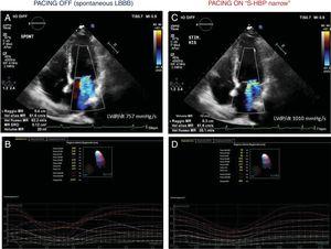 Echocardiography analysis of the same case as in figure 1, at 10 months of follow-up. Panels A and B are recorded during “PACING OFF” which means turning pacing at VVI 40/min. Panels C and D are recorded during “PACING ON” which means during selective His bundle pacing with QRS and left bundle branch block (LBBB) normalization. His bundle pacing reduced mitral regurgitation, increasing left ventricular dP/dt and drastically reduced dyssynchrony indexes. S-HBP, selective His bundle pacing.
