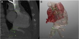 A: computed tomography assessment of superior (20 x 25mm) and inferior vena cava (26 x 30mm). B: three-dimensional-biomodeling simulation of TricValve implantation based on computed tomography. C: superior vena cava prostheses. D: release of inferior vena cava prostheses. E, F: pre- (green) and post-TricValve (orange) implantation pressure curves. Baseline atrial curve shows a ventricularized sharp V wave (21mmHg) and post-TricValve shows an abolished V wave (12mmHg).