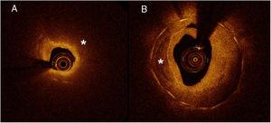 Neoatherosclerosis. A: restenotic tissue with lipid content (signal-poor region with diffuse borders indicated by *). The example shows a case with intense light attenuation that precludes visualization of struts (they are visible only from 6 to 11). B: restenotic tissue with calcification (well-delineated, signal-poor region with sharp borders indicated by *).