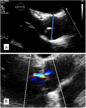 A: measurement of sinus portion of neoaortic root at end-diameter and from leading edge to leading edge (arrow). B: measurement of vena contracta to quantify neoaortic valve regurgitation.