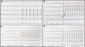 A: the electrocardiogram recorded before the surgical intervention was normal. B: sinus tachycardia and diffuse ST-segment depression during cardiogenic shock. C and D: changes in electrocardiograms showed progressive resolution of the ST-segment and the appearance of widespread, negative T waves.
