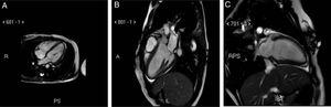 Cardiac magnetic resonance imaging showing hypokinesia of apical and anterolateral portions of the left ventricle with minimal, paradoxical telesystolic bulging without delayed enhancement and with normal ejection fraction.