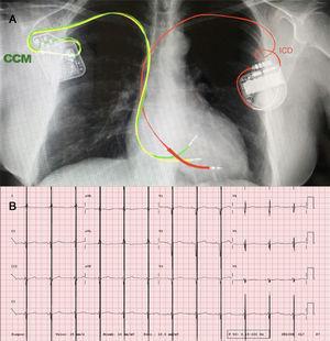 A: posteroanterior thoracic radiograph, showing the ICD generator at the top left, with its leads in the right ventricular apex, and the CCM generator at the top right, with its leads inserted in the interventricular septum. B: electrocardiogram showing the CCM therapy artifact in the middle of the QRS (intermittent treatment not seen in some electrocardiograms).