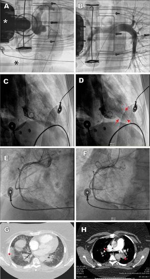A: case 1, aortography depicts a normal aorta and coronary arteries; the white asterisk indicates the chest compression device, and the black asterisk the venous cannula of the extracorporeal membrane oxygenator. B: case 1, pulmonary angiography shows normal findings. C and D: case 2, ventriculography depicts a pattern consistent with inverted tako-tsubo, diastole and systole; the arrows indicate apical hypercontractility. E and F: case 3, thrombotic occlusion of the mid segment of the right coronary artery and revascularization with stent implantation. G: case 4, CT angiography depicts pulmonary infarction (asterisk) and patchy peripheral opacities consistent with SARS-CoV-2 pneumonia. H: case 4, CT angiography shows thrombotic occlusion of both pulmonary arteries (asterisks). This figure is shown in full color only in the electronic version of the article.