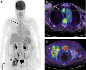 Pacemaker patient, 84 years, last manipulation 3 years earlier. PET/CT was performed for fever and methicillin-sensitive Staphylococcus aureus bacteremia. A: volumetric imaging. B: lead uptake in upper cava according to PET/CT fusion imaging (arrow). C: an unsuspected septic focus on the right hip with periarticular fluid collections (asterisk). Considering the baseline situation, conservative treatment was administered consisting of cefazolin i.v. and oral rifampicin for 6 weeks. Blood cultures were negative on day 5. This treatment was followed by oral cephalosporin indefinitely without new episodes of infectious exacerbation during the subsequent year. PET/CT, positron emission tomography-computed tomography.