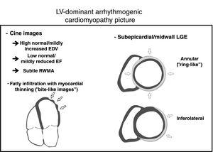 Cardiac magnetic resonance hallmarks in arrhythmogenic cardiomyopathy. EDV, end-diastolic volumes; EF, ejection fraction; LGE, late gadolinium enhancement; LV, left ventricular; RWMA, regional wall motion abnormalities.