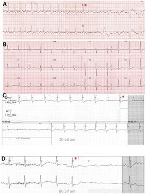 A: rhythm strip obtained by the emergency healthcare service for one of the syncopal episodes. B: 12-lead electrocardiogram at hospitalization. C and D: telemetry recordings during the patient's admission.