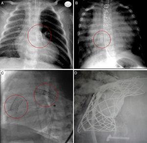 Postoperative X-rays showing the stents (circles). A: right ventricular outflow tract. B: atrial septum. C: right ventricular outflow tract and ductus. D: valved conduit in the pulmonary trunk and left pulmonary artery (2 overlapping stents).