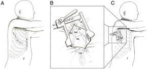 Different accesses for minimally invasive pediatric cardiac surgery. A: graphical representation of the 3 different types of access for minimally invasive cardiac surgery used at the University of Padua. 1, right lateral minithoracotomy. 2, right anterior minithoracotomy. 3, midline lower ministernotomy. B: close-up. C: graphical representation of a right lateral minithoracotomy with the anatomical structures that can be approached through this access. Ao, aorta; IVC, inferior vena cava; PV, pulmonary veins; RA, right atrium; SVC, superior vena cava.