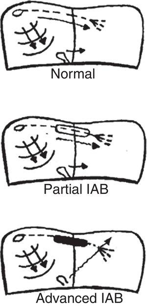 Atrial activation in healthy (normal) patients and in patients with partial and advanced interatrial block (IAB).