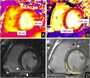 Cardiac magnetic resonance imaging in a 26-year-old woman with COVID-19 myocarditis. Mid-ventricular short axis view. A: T2 map. B: native T1 map. C: late gadolinium enhancement (LGE). D: quantification of late gadolinium enhancement. The study revealed slightly increased values on T2 maps (53ms vs 45ms of remote myocardium) and prolonged native T1 values (1303ms vs 1131ms of remote myocardium) in basal and mid-inferoseptal and inferior myocardial segments. These segments showed mesocardial and subepicardial enhancement on LGE sequences (arrowhead in C). The extent of LGE corresponded to 14.2% of the total ventricular mass.