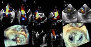 A: TEE showing severe mitral regurgitation. B: TEE mid-esophageal view of the torrential tricuspid regurgitation. C: TEE showing gaps along the line between the anteroseptal and posteroseptal commissures (arrows). D: 3D TEE showing clip at the mitral valve. E: TEE of insertion of leaflets in the clip and result. F: 3D TEE of the mitral clip final result. TEE: transesophageal echocardiography.