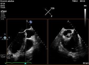 2D transesophageal echocardiography image of the aortic valve with orthogonal planes to the long axis (135°) and short axis (45°).