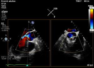 Color Doppler transesophageal echocardiography of the aortic valve with orthogonal planes to the long axis (135°) and short axis (45°).