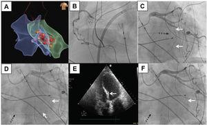 Coronary angiography and echocardiography from during the procedure. The arrows indicate, respectively, the atrioventricular nodal (AVN) artery and the area of the septum with contrast uptake. A: electroanatomical map (Ensite Precision, Abbott) showing the different radiofrequency applications from the right atrium, the coronary sinus, the right ventricle, and the left ventricle on an antero-posterior projection. B: right coronary artery on left anterior oblique (LAO) projection. C: left coronary artery (LAO projection; the arrow indicates the AVN artery). D: the arrow indicates the angioplasty guidewire and the coaxial balloon catheter in the AVN artery (LAO projection). E: echocardiography (apical view) during the selective infusion of echo contrast; the arrow indicates the area of the septum with uptake of echo contrast. F: left coronary artery after the selective injection of ethanol; the arrow indicates the amputated AVN artery (LAO projection).