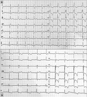 Electrocardiograms showing characteristic features of apical ventricular hypertrophy in 2 patients following heart transplant. A: complete right bundle branch block with increased voltages and criteria indicating left ventricular hypertrophy. B: increased voltages with criteria of left ventricular hypertrophy and deep T-wave inversion in the precordial leads.