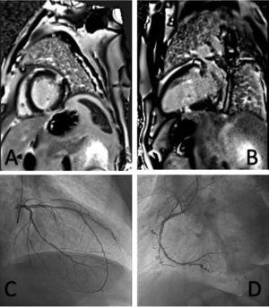 A, cardiac magnetic resonance imaging, short axis view. B, cardiac magnetic resonance imaging, long axis view. C, left coronary angiography. D, right coronary angiography.