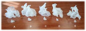 3D printed real dimensions models of fetal hearts with clear resin (front line) and matched 3D printed version of the same hearts magnified 5 times (back line). A: D-transposition of the great arteries (D-TGA) diagnosed at 30 weeks of gestation (WG). B: complete atrioventricular septal defect diagnosed at 27 WG. C: tetralogy of Fallot diagnosed at 25 WG. D: D-TGA, ventricular septal defect and pulmonary stenosis diagnosed at 22 WG. E: interrupted aortic arch (type B) diagnosed at 22 WG.