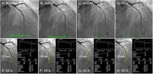 Quantitative coronary angiography analysis of the distal segment. A, B, C, D: 6-month vasomotor test angiographic images at baseline, acetylcholine doses, and nitroglycerin. Stent edges are marked with yellow lines. E, F, G, H: quantitative coronary angiogram of matched distal segments between the different vasomotor drugs. The mean lumen diameter of matched segments is shown in each respective image. NTG, nitroglycerin; QCA, quantitative coronary angiography.