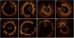Main optical coherence tomography qualitative findings. A: absent neointima; B: homogeneous neointima; C: heterogeneous neointima; D: layered neointima; E: RUTTS (ratio of uncovered to total stent struts) ≥ 30%, uncovered struts are shown with *; F: major coronary evagination; G: incomplete stent apposition; H: fibro-lipidic neoatherosclerotic plaque.