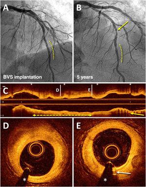 Angiographic result on optical coherence tomography of a bioresorbable vascular scaffold (BVS) implanted 5 years prior in the left anterior descending artery (LAD). An 83-year-old man who, in 2013, for stable angina, received a BVS (Absorb) (3 × 18mm) in a lesion in the distal LAD (dashed line), with an excellent result (A). In 2018, coronary angiography was repeated due to stable angina, which showed the good result of the BVS (dashed line) and a de novo lesion in the mid segment of LAD (arrow) that was treated with a drug-eluting stent (B). Subsequent imaging with optical coherence tomography showed an excellent result with the recently implanted drug-eluting stent (C; arrow) and the complete disappearance of the BVS (C-E); in that coronary segment, there was only an unobstructed fibrous plaque (D; dashed line with arrows) and the residual radiopaque markers (platinum) at the ends of the device (E; arrow).