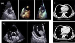 A: transesophageal echocardiogram at diagnosis. B: follow-up transthoracic echocardiogram after catheter removal. C: computed tomography of the chest, before and most recent, showing a new mass adhered to the atrial septum.