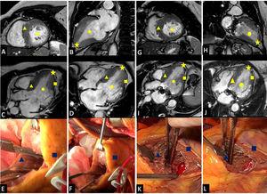 Left ventricular diastolic volumes before surgery and during follow-up and images of the surgical field. Preoperative magnetic resonance images showing a 2-chamber short-axis view (A), a 2-chamber long-axis view (B), a 3-chamber long-axis view (C), and a 4-chamber long-axis view (D). E, ventriculotomy. F, surgical field before myectomy. Follow-up magnetic resonance images showing a 2-chamber short-axis view (G), a 2-chamber long-axis view (H), a 3-chamber long-axis view (I), and a 4-chamber long-axis view (J). K and L, surgical field after myectomy. Circle, left ventricular end-diastolic volume; triangle, interventricular septum; square, left ventricle free wall; star, left ventricular apex.