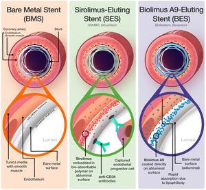 Overview of bare metal stents, sirolimus-eluting stents, and the biolimus A9-eluting stent. Illustration not to scale, 210*195mm.