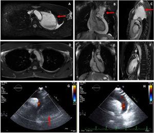 Pericardial cyst (arrows) on cardiac magnetic resonance on axial (A), coronal (B), and sagittal (C) views. Cardiac magnetic resonance at one month post-discharge showing complete resolution; axial (D), coronal (E), and sagittal (F) views. Echocardiogram on suprasternal view on admission (G: with pericardiac cyst, arrow) and at 1 month after resolution (H).