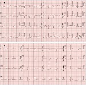 A: electrocardiogram obtained in the emergency department. Sinus tachycardia at 105 bpm, normal axis (90°). Normal PR interval (120ms). Narrow QRS. Nonsignificant Q wave in the inferior wall. Without acute repolarization abnormalities. Corrected QT in the normal range. B: electrocardiogram obtained 2 days later in the cardiology clinic. Sinus rhythm at 75 bpm, normal axis. Normal PR interval (120ms), with a PR segment decrease. Narrow QRS. Concave and generalized ST-segment elevation. Corrected QT in the normal range.